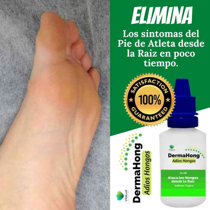 DERMAHONG – TRATAMIENTO ANTIHONGOS PARA UÑAS Y PIEL