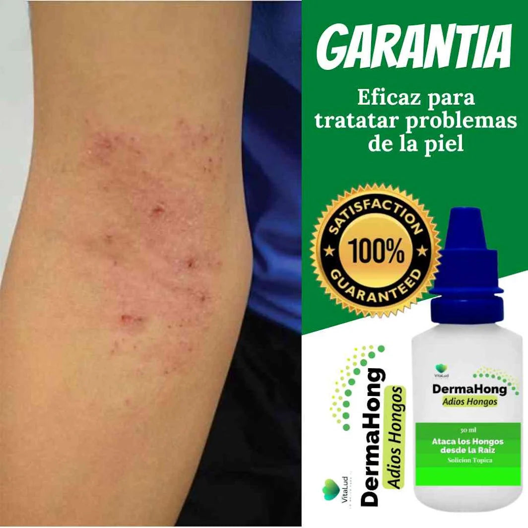 DERMAHONG – TRATAMIENTO ANTIHONGOS PARA UÑAS Y PIEL