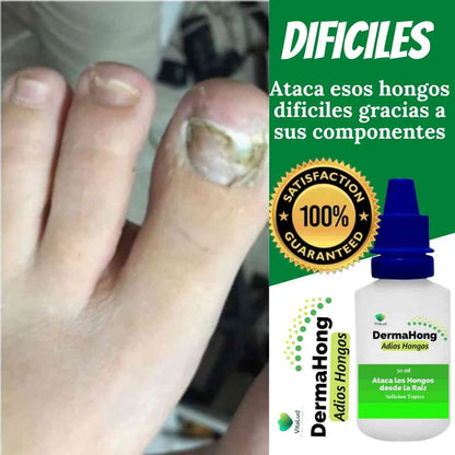 DERMAHONG – TRATAMIENTO ANTIHONGOS PARA UÑAS Y PIEL
